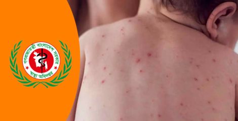 হামের উপসর্গে আরও ৩ শিশুর মৃত্যু